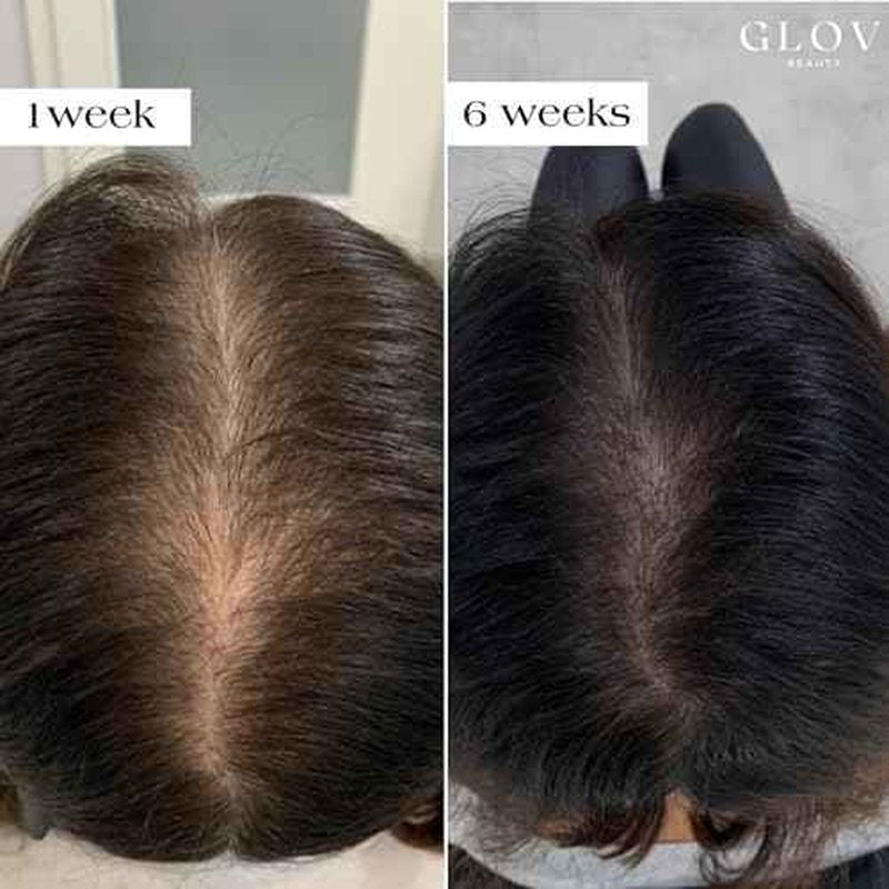 Glov Beauty Micro Infusion Hair Renewal Kit ? 0.25mm Gold Derma Stamp with Hyaluronic Acid, Peptide & Botanical Serum Ampoules | Hydrating Scalp Treatment for Fuller, Thicker-Looking, Healthier Hair