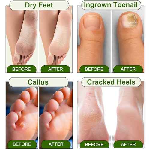 Epsom Salt Foot Soak, 10Pack Tea Tree Oil and Lavender Oil Epsom Salts for Soaking, Dead Sea Salt Spa Pedicure Care Softens Thick Calluses & Corns, Athletes Foot, with feet scrubber