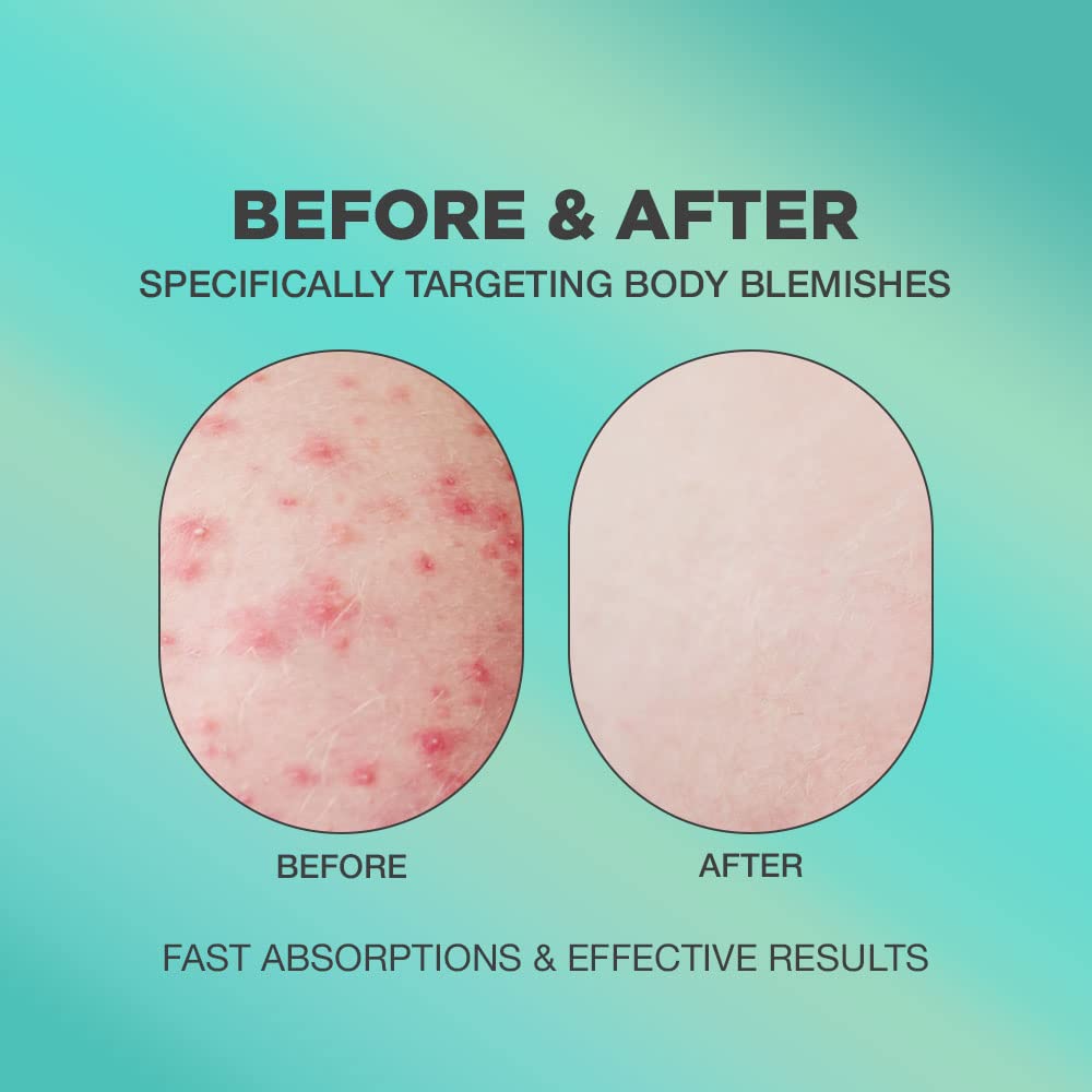Butt Acne Spot Cream & Butt Acne & Ingrown Hair Serum | | AHA & BHA Butt Acne and Ingrown Hair Cream and Serum for Bikini Area | After Waxing Skin Care
