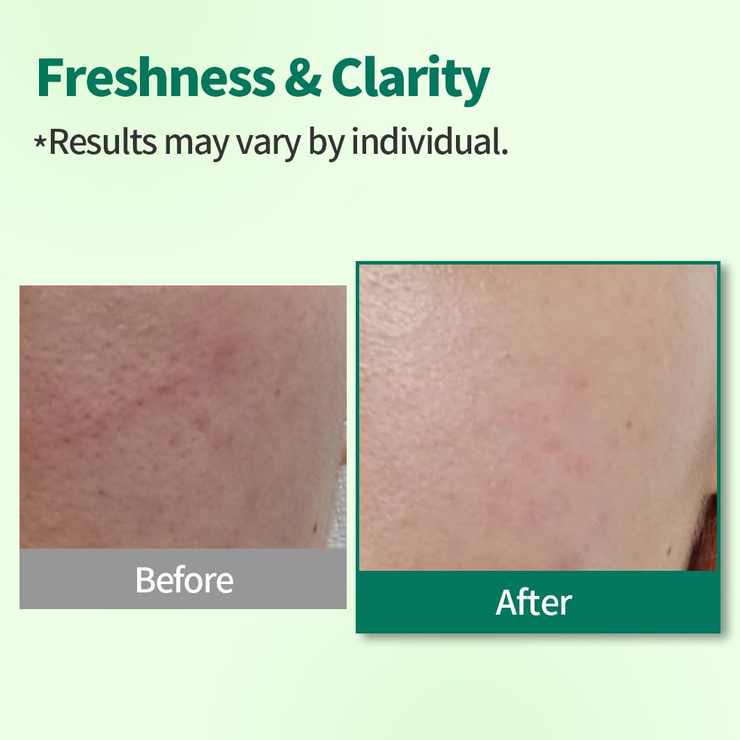 Tea Tree Foam Cleanser - BHA & Salicylic Acid Face Wash for Blemish-Prone Skin | 5.07 Fl Oz, pH 6.5