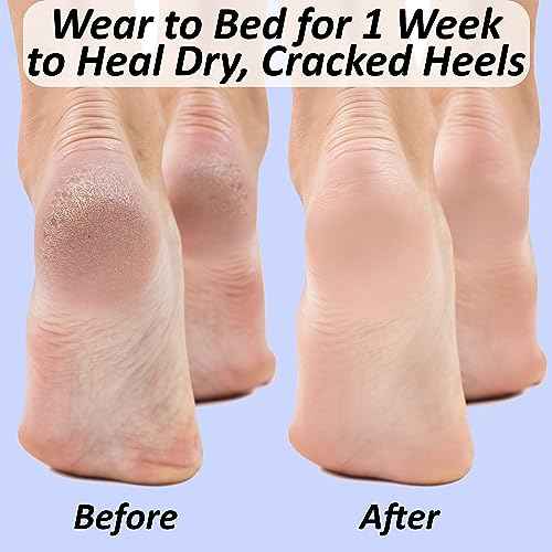 Moisturizing Socks for Cracked Heel Treatment: Socks for Cracked Heel Repair, Silicone Toeless Socks, Spa Gel Socks for Dry Cracked Feet Women, Lotion Moisture Pedicure Socks
