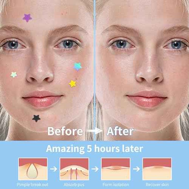 Pimple Patches for Face, 3 Size 280 Counts Hydrocolloid Acne Patches, Cute Star Pimple Stickers with Salicylic Acid, Tea Tree Oil & Calendula Oil, for Covering Zits and Blemishes