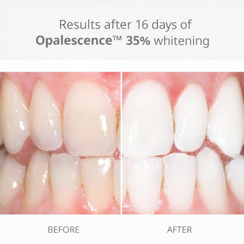 Opalescence 35% Gel Syringes Teeth Whitening - Refill Kit (4 Syringes Total) Carbamide Peroxide. Made by Ultradent, in Melon Flavor. Tooth Whitening Refill Syringes 5404-2