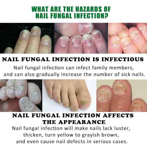 7 days Nail Treatment, Ginger Nail Treatment, Nail Growth Serum, Ginger Nail Serum, Nail Nutrient Oil Strengthener Oil (2 PCS)