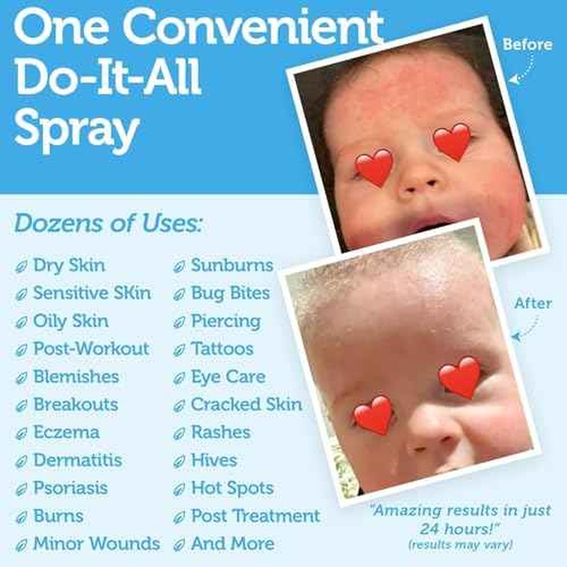 Happy Skin Hypochlorous Acid Spray for Face Travel Size ? Extra Strength Natural Full Body Cleansing Toner for Acne ? Soothe, Hydrate & Repair Dry, Sensitive Skin ? pH Balanced, Non-Toxic 2oz