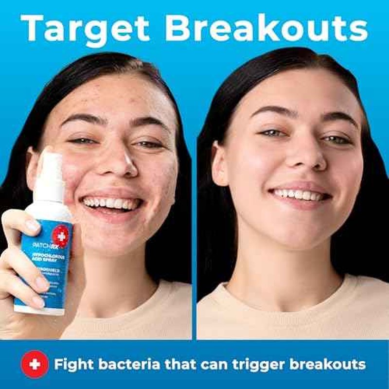 Hypochlorous Acid Spray for Face (8oz, Reduces Acne), Targets Bacteria - HOCL Facial Cleanser Acne Spray for Face, Body, Eczema, Pimples, Breakouts & Overall Skin Recovery (Reduces Redness)
