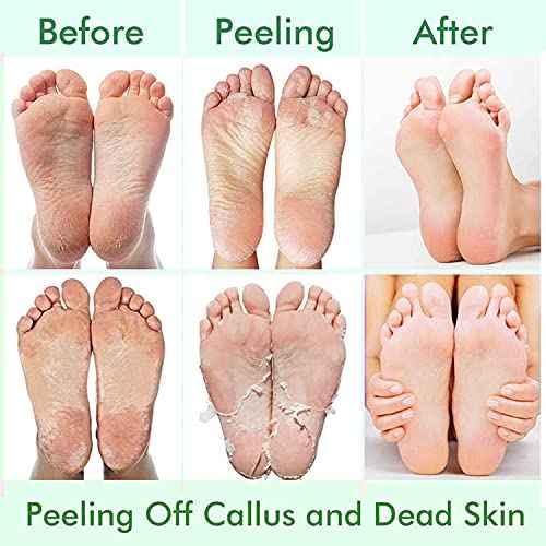 5 Pack Foot Peeling Mask,Exfoliator Peel Off Calluses Dead Skin Callus Remover,Foot Mask for Dry Cracked Feet,Foot Peel Masks for Men and Women Feet Peeling Mask for Stocking Stuffers