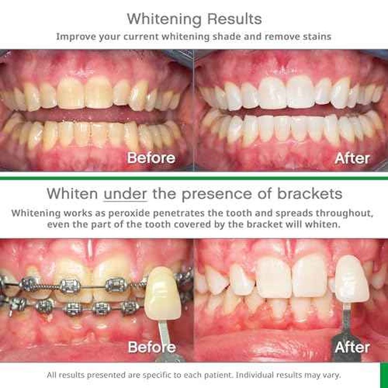 Opalescence Go - Prefilled Gel Teeth Whitening Trays (2 Packs / 20 Treatments) - 15% Hydrogen Peroxide - Teeth Whitening Kit -Mint - 5194-2