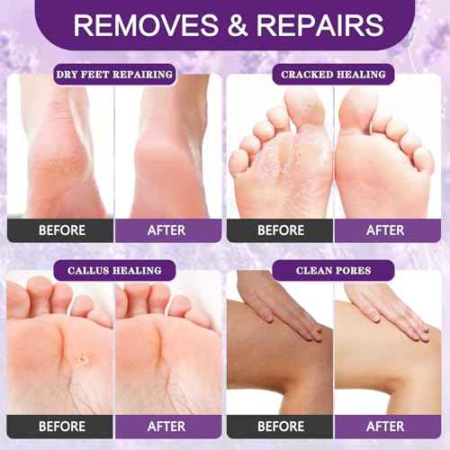 Foot Callus Remover Gel Foot Files Kit Heel Foot Callus Remover Gel Exfoliator Dead Skin Remover Pedicure Foot Spa Products Home Pedicure Foot Spa Supplies for Rough, Dry, Cracked Skin