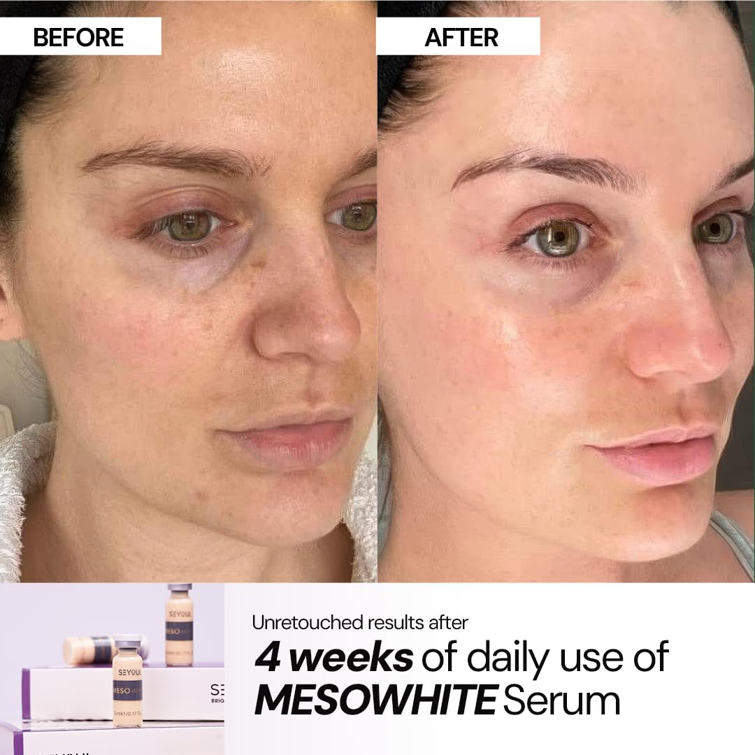 SEYOUL Meso White Brightening Serum for Dark Spots & Uneven Skin Tone – Diacetylboldine, Niacinamide & Hyaluronic Acid – Hydrating Facial Ampoules – 6 Vials