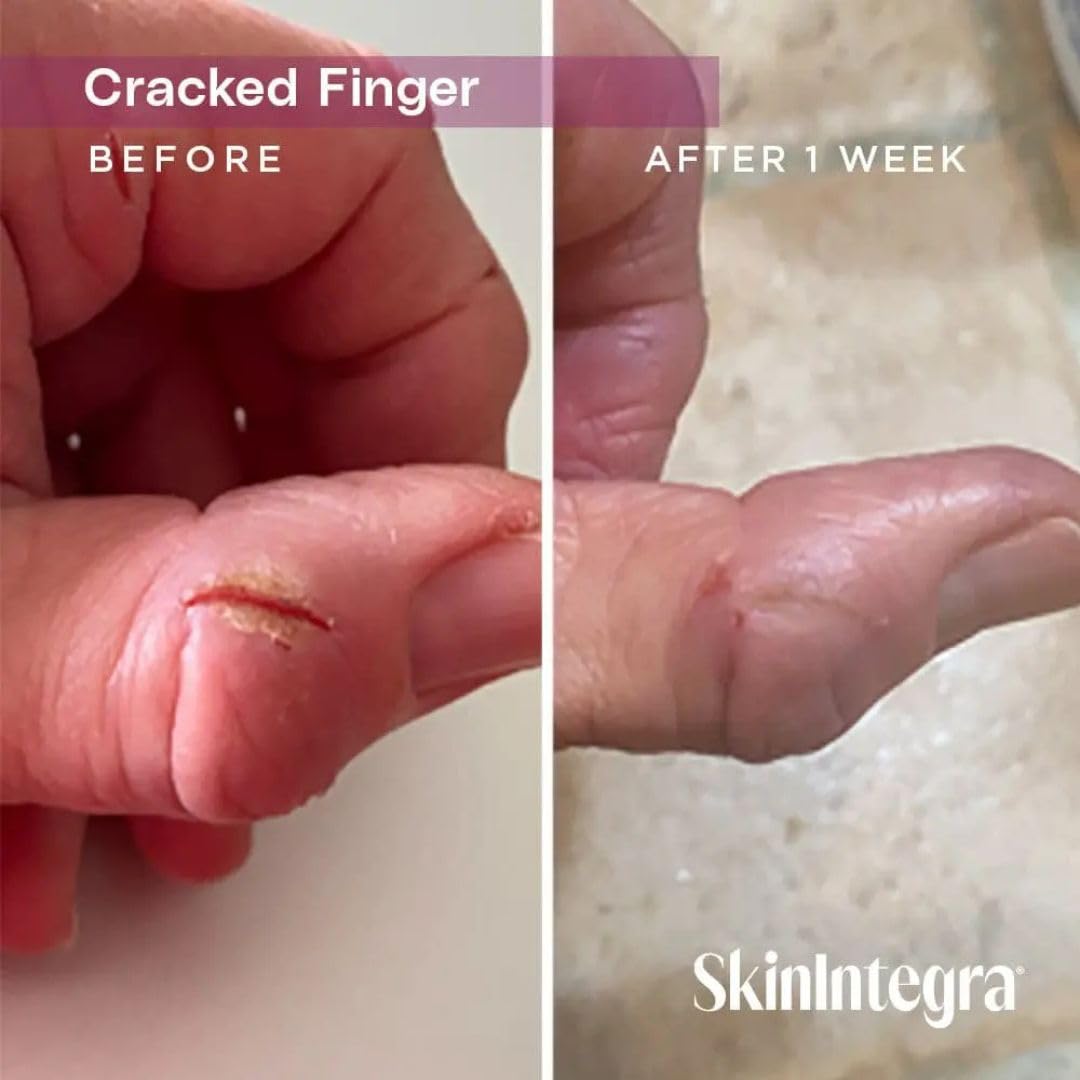 SkinIntegra Rapid Crack Repair Cream, 25% Urea with Lactic Acid, Restores Cracked Heels and Diabetic Feet, Post-Surgery Scar Care, Fragrance-Free Barrier Cream, 3 oz