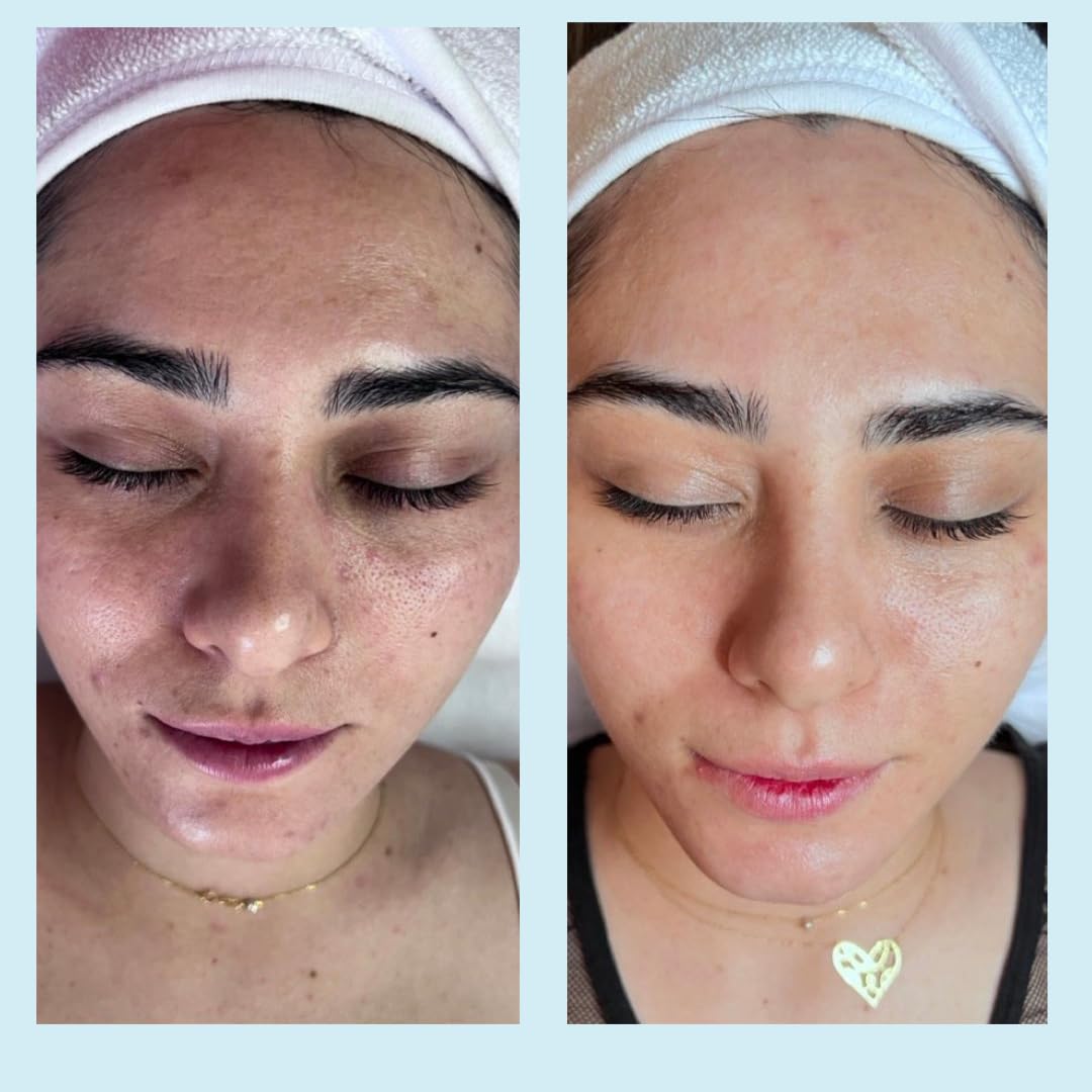 Salicylic Gel Chemical Peel - Enhanced with Green Tea Extract and Tea Tree Oil