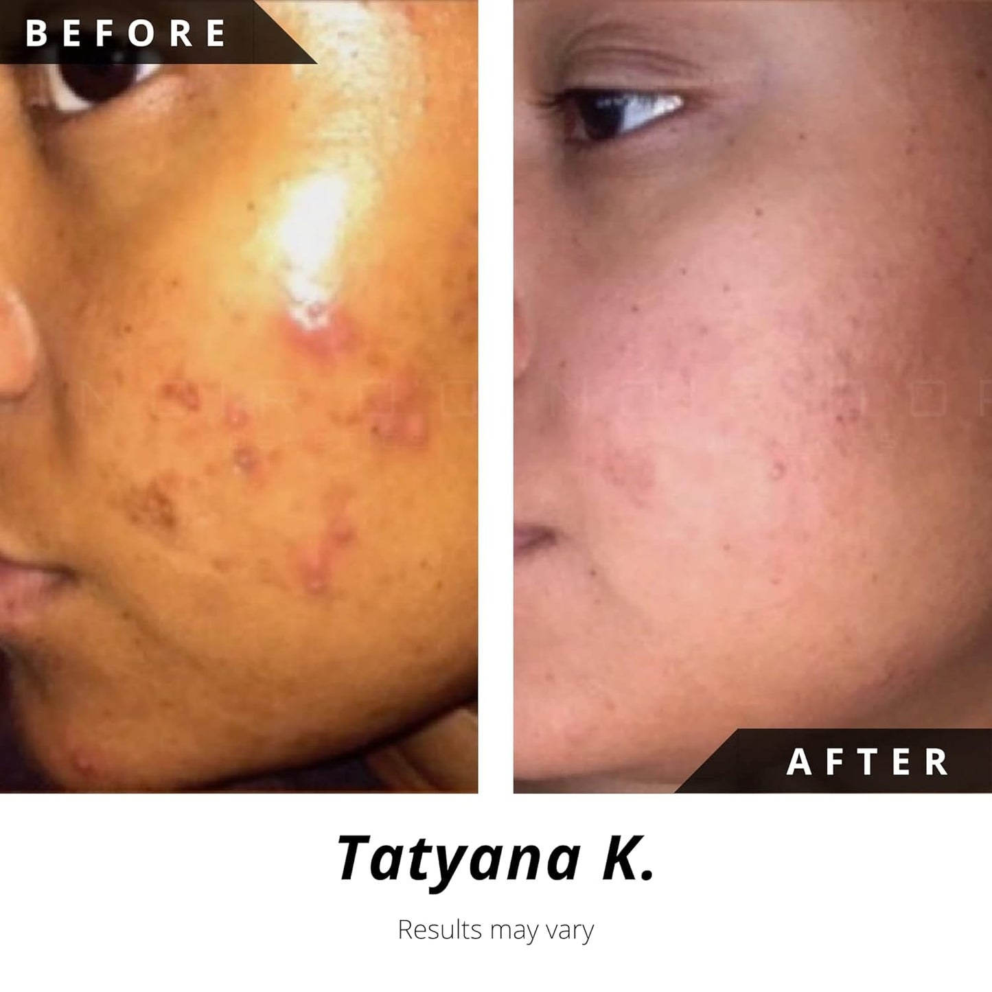 Acne Scar Treatment - Three Step Hyperpigmentation Repair Set | Normal to Oily Skin, Dark Spot Remover