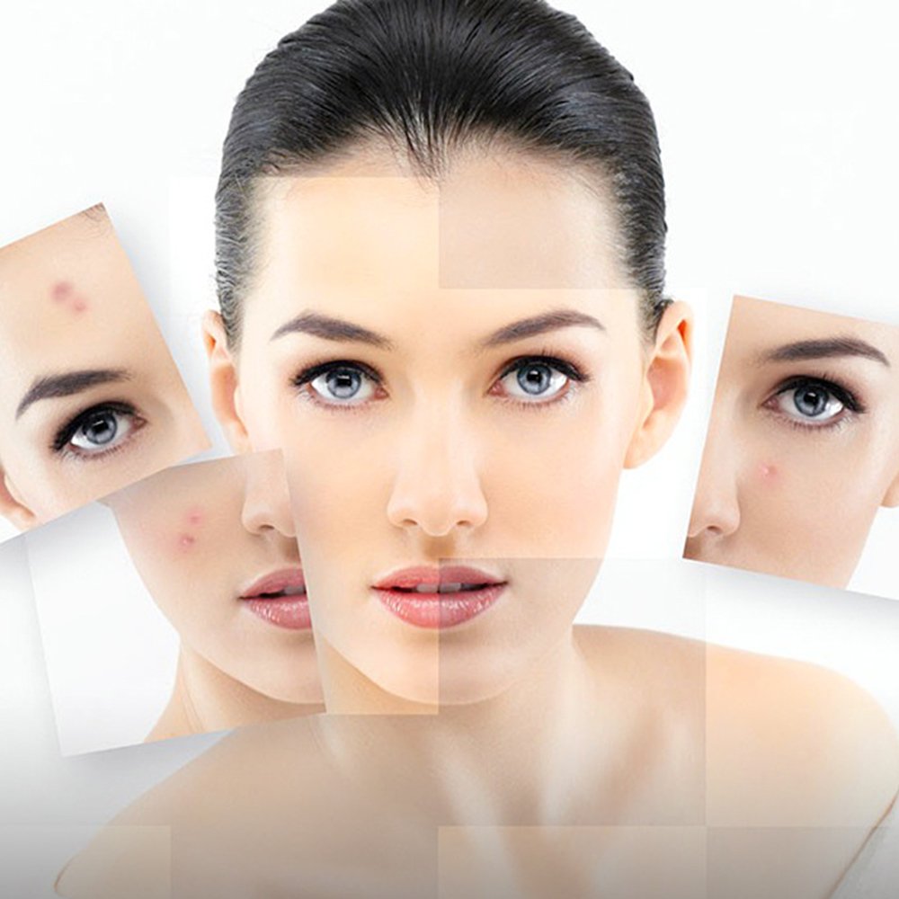 (0BQY0733) Acne Removal Rejuvenation Moisturizing Mask