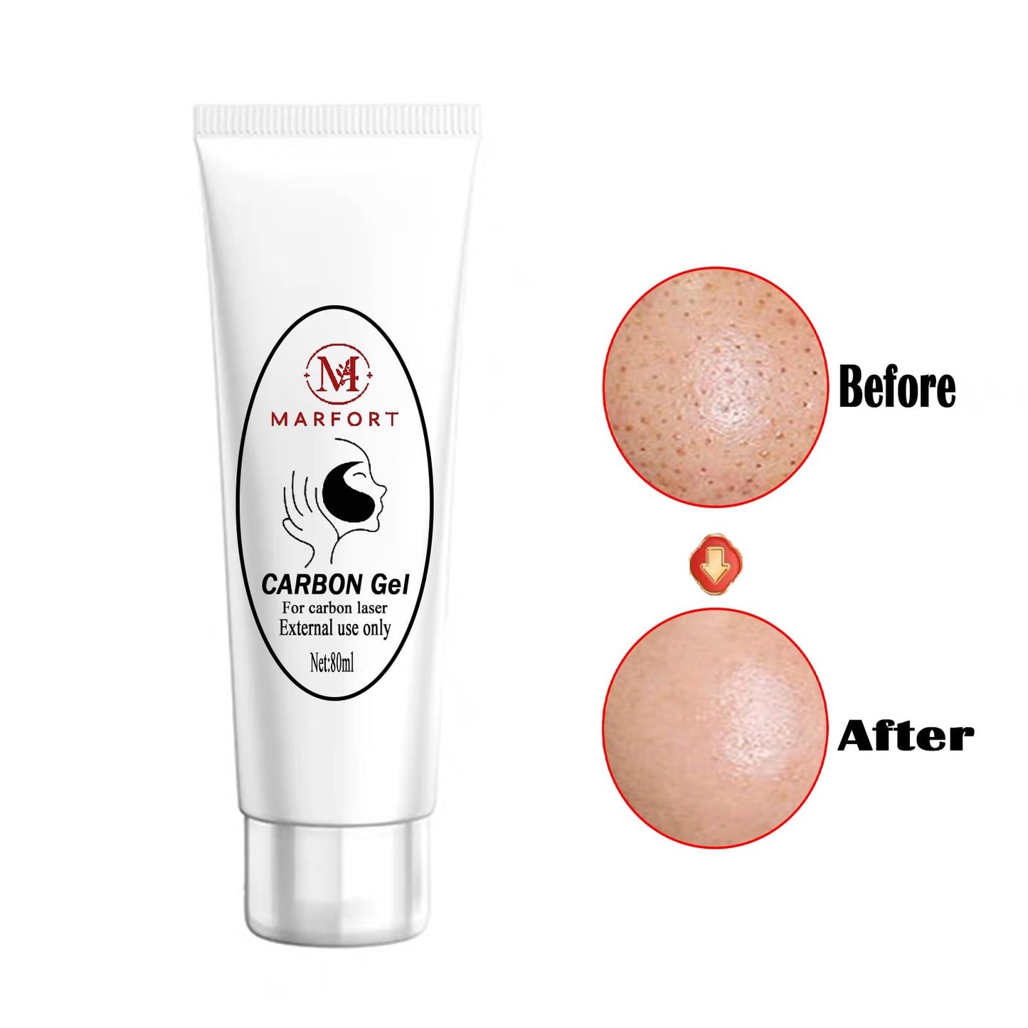 Marfort Carbon Peel Cream Gel for Facial Skin Rejuvenation Black Doll Deep Cleaning with Carbon Gel Safe & Effective（80ml）
