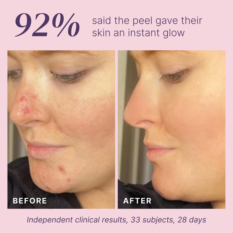 Glycolic Acid Peel 40% Professional Chemical Peel for Face at Home - Intense Alpha Hydroxy Acid Skin Peel For Acne Scars, Collagen Boost, Wrinkles Fine Lines - Liquid Exfoliant Face Peel Mask, 1 Fl Oz