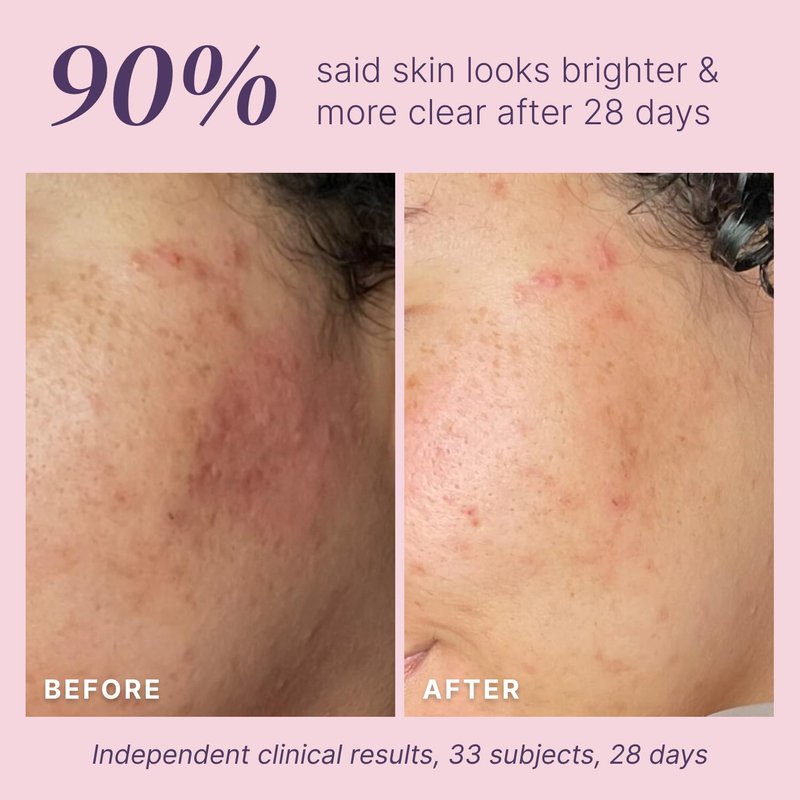 Glycolic Acid Peel 40% Professional Chemical Peel for Face at Home - Intense Alpha Hydroxy Acid Skin Peel For Acne Scars, Collagen Boost, Wrinkles Fine Lines - Liquid Exfoliant Face Peel Mask, 1 Fl Oz