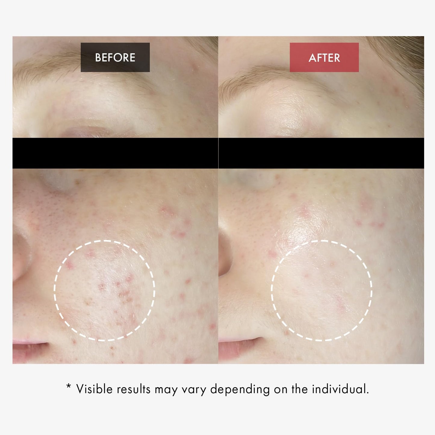 DR.WANT Red BHA Gel, AHA PHA LHA Exfoliating for Blemish-Prone Skin
