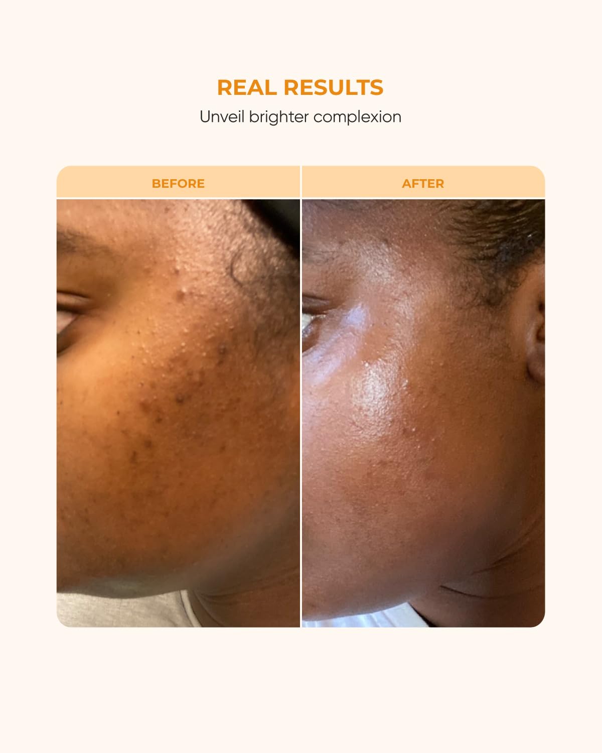 Buttah Skin 15% Vitamin C Serum 1 FL oz 30mL - For Uneven Skin Tone - Ferulic Acid - Anti-Dark Spot Vitamin C Serum For Face