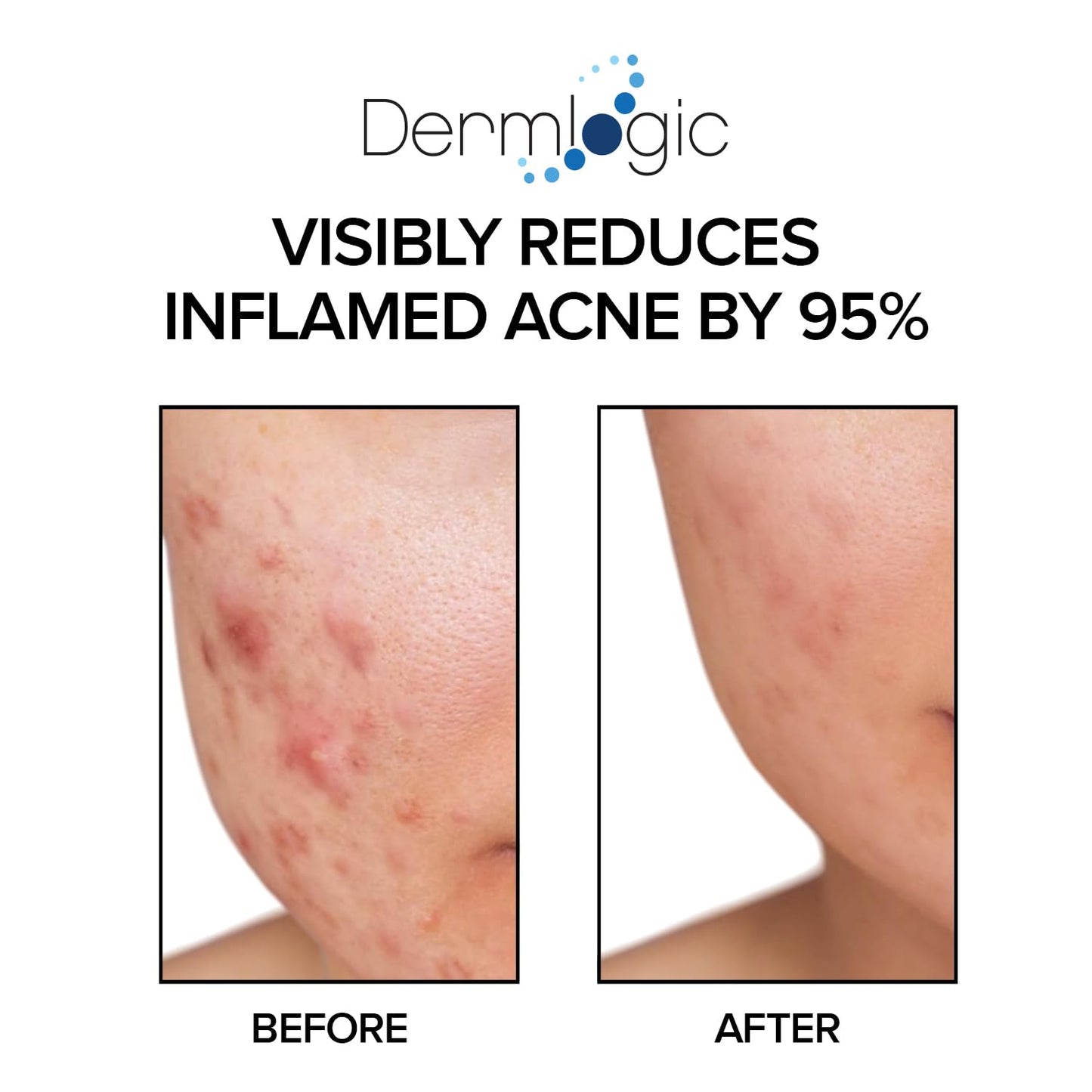Dermlogic Acne Treatment Pads - Glycolic, Lactic & Salicylic Acid for Oily Skin | Clears Clogged Pores & Breakouts
