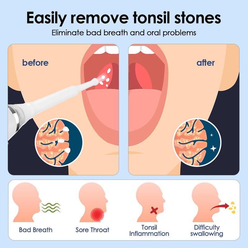 Electric Tonsil Stone Remover – High-Precision & Painless Cleaning, Food-Grade Suction Tool with LED Light, 12 Attachments & Vacuum Cleaning for Tonsil Stones, Bad Breath Relief