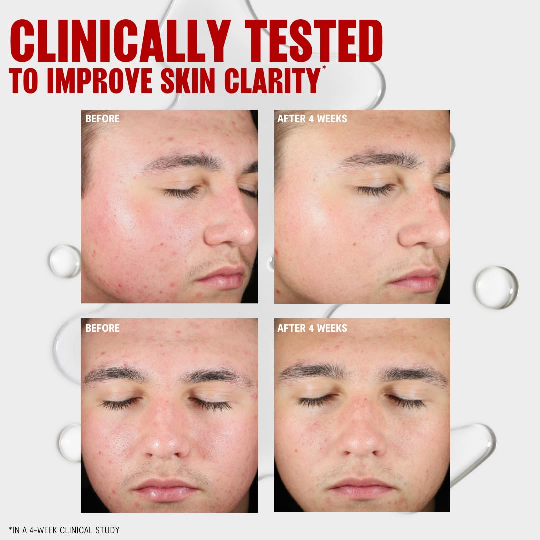 Thayers Blemish Clearing Salicylic Acid Tone