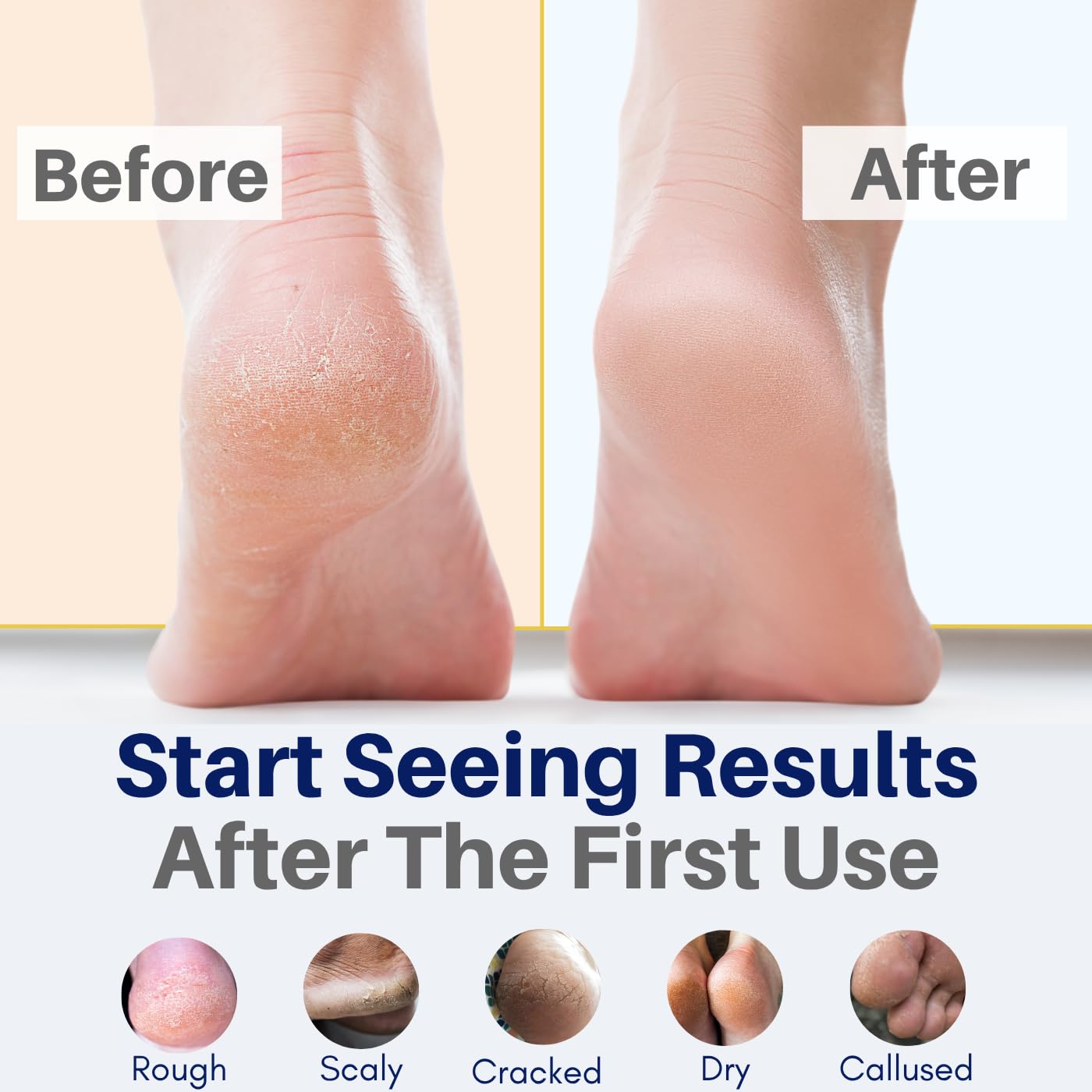 All Natural Foot Cream for Cracked Heels & Dry Feet – USA Made Organic Foot Balm for Callus Softening – Hydrating Foot Care Moisturizer with Peppermint, Tea Tree, Lavender & Eucalyptus