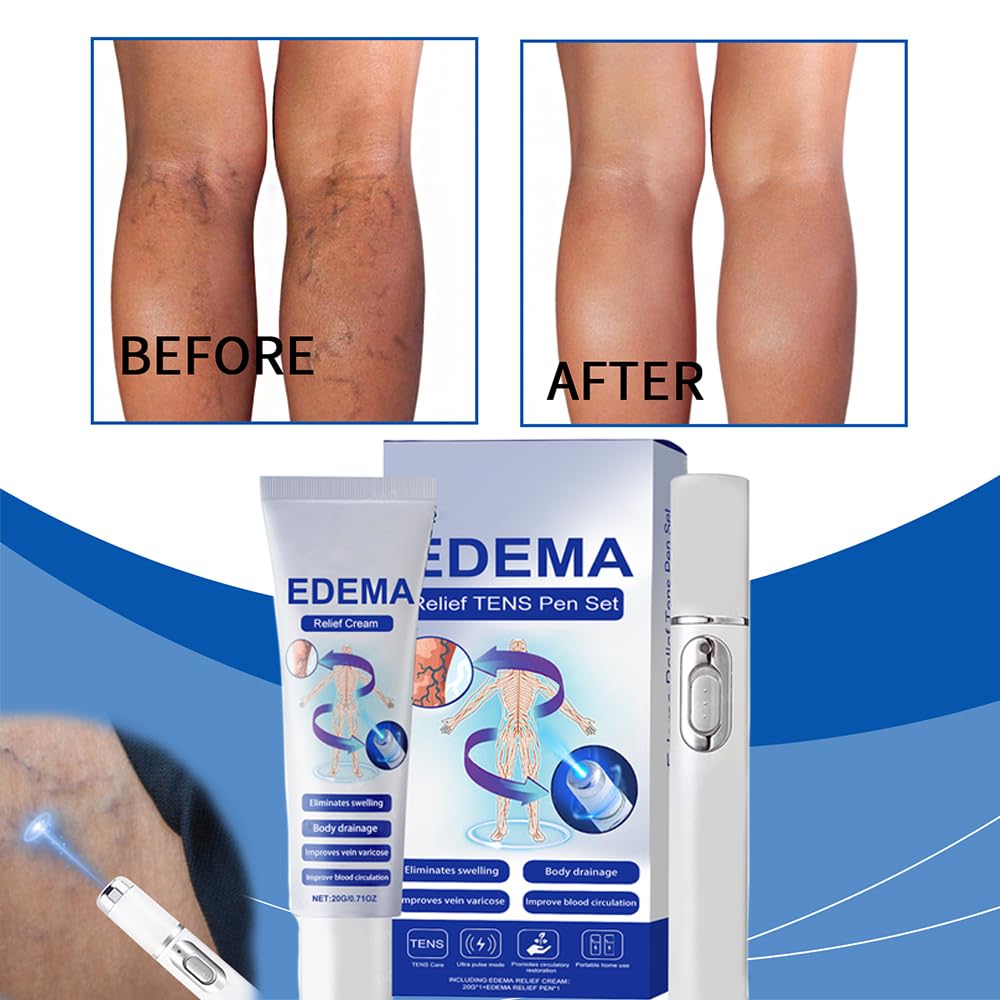 etitek 2 Pack Varicose Veins Treatment for Legs,Varicose Veins Blue Light Therapy Set Fast Soothe Blood Circulation Natural Formula Smooth Skin