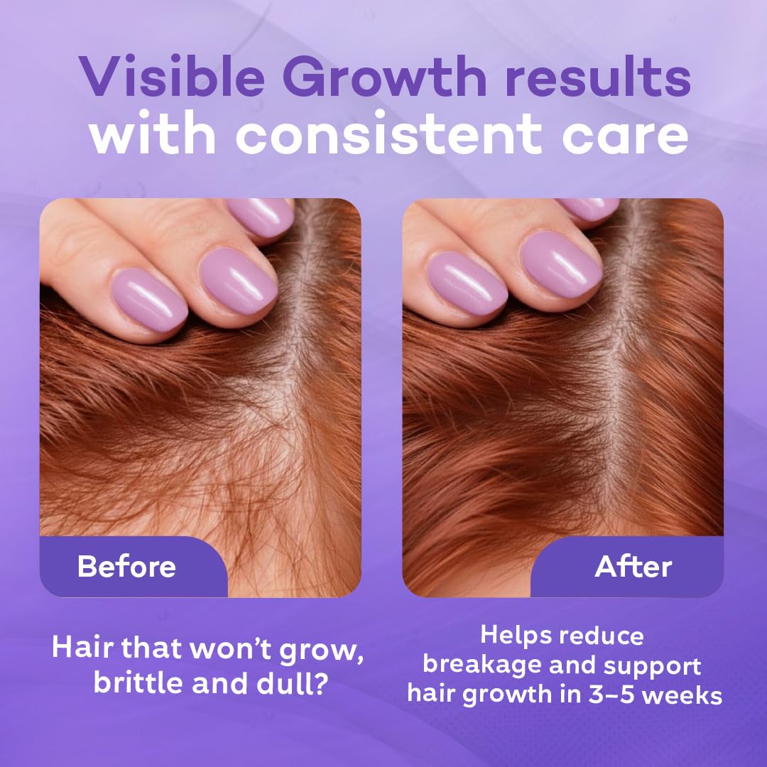 Onion and Rosemary Hair Growth Shampoo for Hair Loss and Thinning, Sulfate-Free, 16.9oz, 621 By Kika Nieto