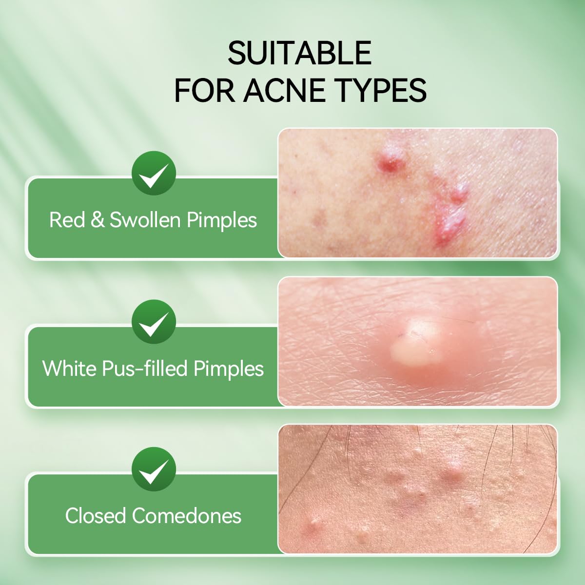 LANBENA Acne Spot Treatment Serum - Overnight Drying Lotion for Pimples & Blemishes | 1 Fl Oz