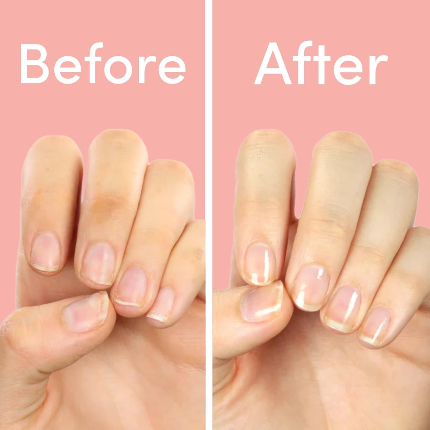 ella+mila Nail Strengthener and Growth Treatment - First Aid Kiss Nail Hardener for Damaged Brittle Thin Nails - Strengthening Polish with Vitamin E - Vegan (2-Pack)
