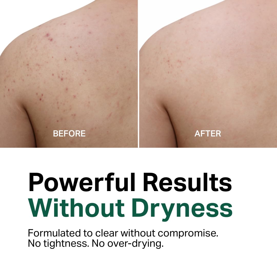 Y'OUR Aloe Vera Anti-Acne Body Wash | Gentle & Non-Drying Formula | Smooths Texture & Evens Tone | Clears Bacne & Breakouts for Women + Men, Paraben & Sulfate Free