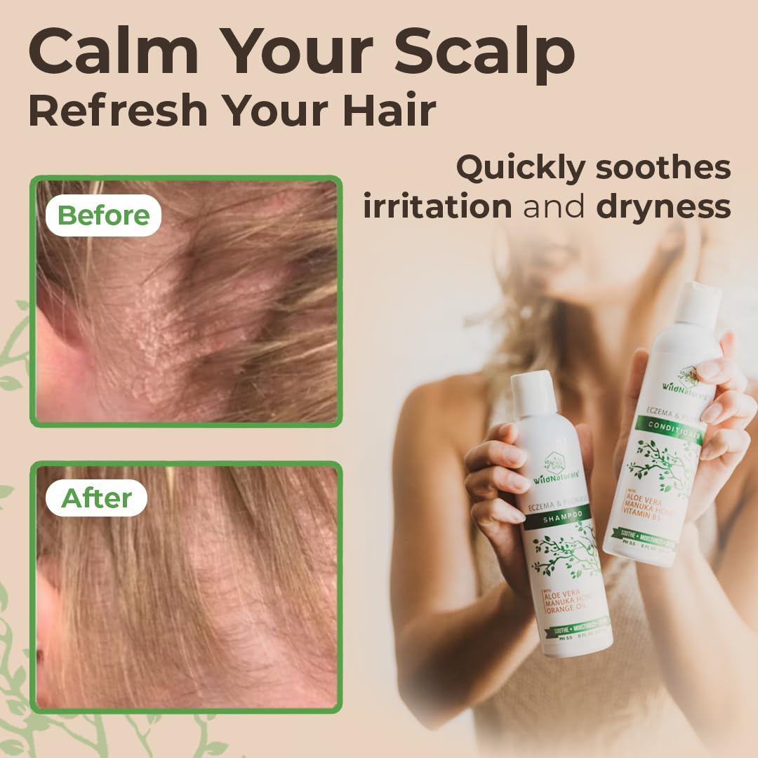 Wild Naturals Eczema and Psoriasis Treatment - Anti-Dandruff Deep Conditioner for Damaged, Dry Hair and Seborrheic Dermatitis Scalp