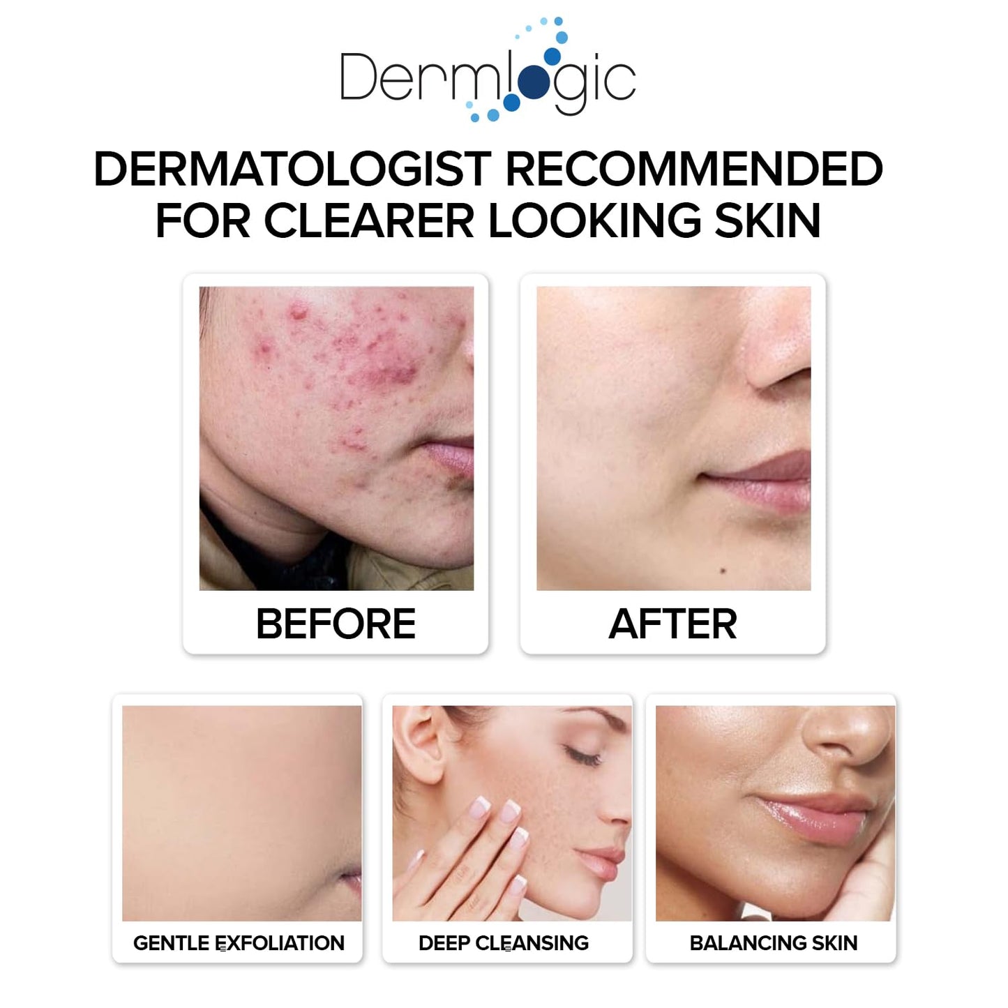 Dermlogic Acne Treatment Pads - Glycolic, Lactic & Salicylic Acid for Oily Skin | Clears Clogged Pores & Breakouts