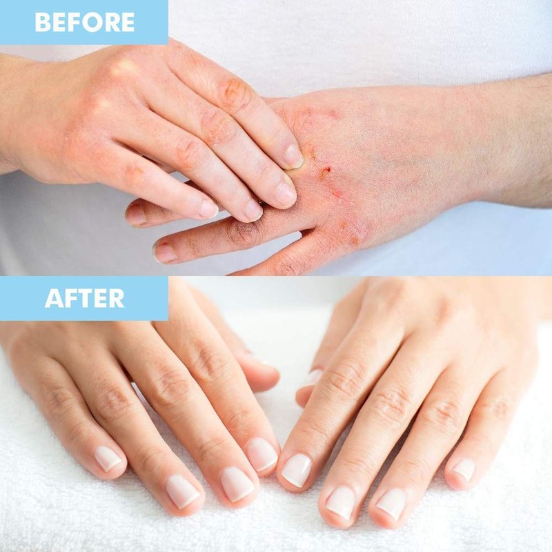 Bodipure Premium Hand and Foot Mask | Moisturizing Kertain Gloves & Socks | Hydrating Dull Dry Hands, Cracked Heels, Callus Softening & Nail Strengthening | Chemical-Free Feet Treatment | (6+6 Pack)