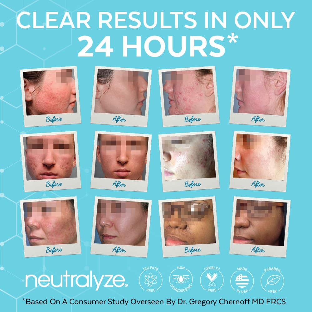 Neutralyze Acne Pads with DuoClear Acid System — 1% Salicylic + 1% Mandelic Dual-Textured Exfoliating Toner Pads for Face, Back & Body — Fragrance-Free, Alcohol-Free — Step 2 (100 ct)