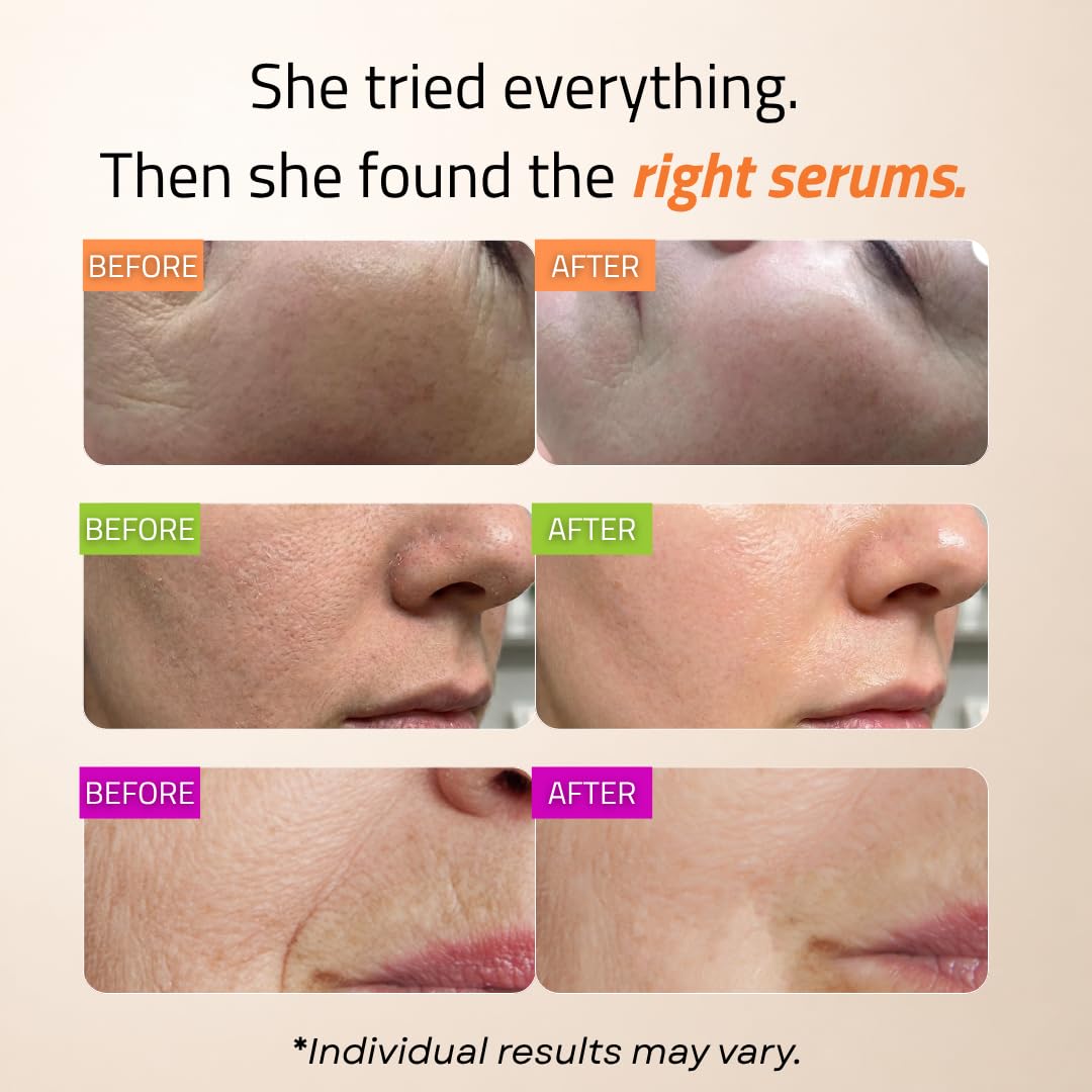 GLEOW Skincare Set: Retinol, Vitamin C, and 99% Hyaluronic Acid Serum, Face Serum Set Targets Appearance of Uneven Skin and Dryness, Total Package Serum Set 3x1 oz