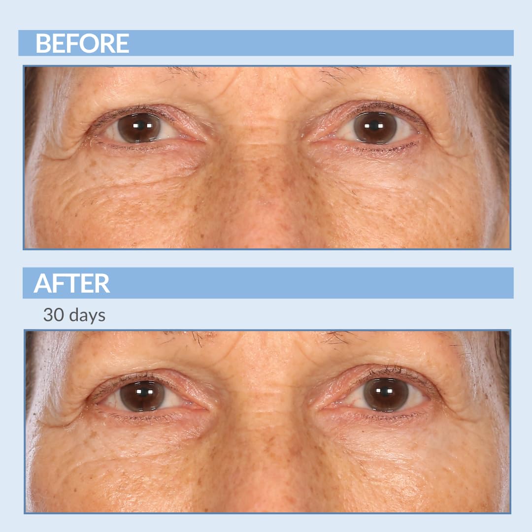Serious Skincare - Retinol A Eye XR Under Eye Cream Concentrate - Reduce Fine Lines, Dark Circles & Puffiness - Daily Wrinkle Cream - Anti-Aging Skin Care Treatment for Women and Men - 0.5 oz