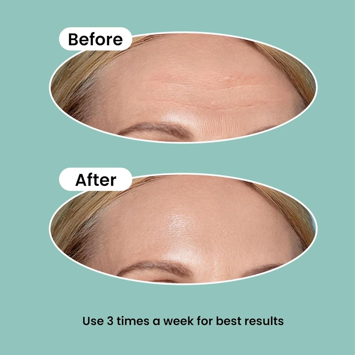 NURIVE Advanced Wrinkle Patches 20ct Smile Line, Frown Line Wrinkle Patches for Facial Korean Skin Care Face Wrinkle Tape Invisible Overnight with Retinol & Collagen (Large (Forehead))