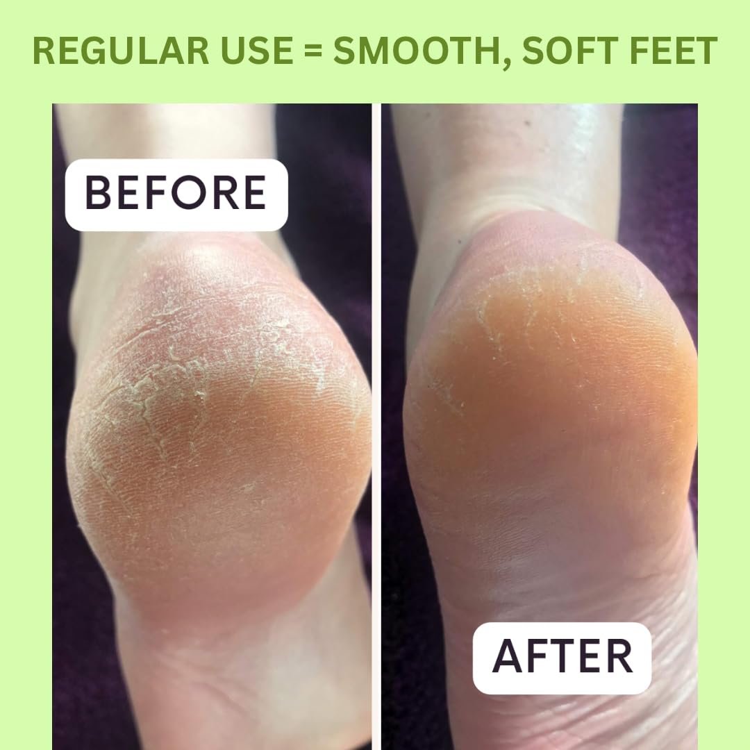 Get Fresh Relief For Tattered Tootsies 3-step at Home Foot Treatment 15.2 x 30.5 x 15.2 cm Feet Care Kit With Lemongrass Scent Includes Scrub For Cracked Heels Callus Remover Cream