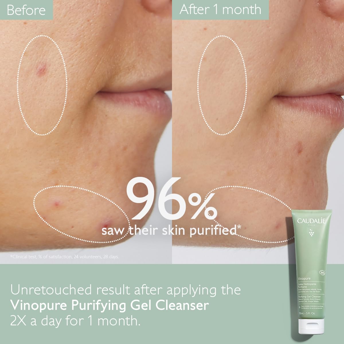 Vinopure Salicylic Acid Cleanser - Pore Purifying Gel for Clear Skin | 150 mL