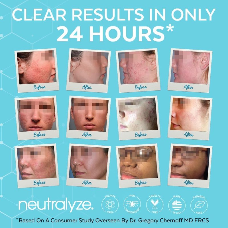 Neutralyze Acne Moisturizer - Maximum Strength 2% Mandelic & Salicylic Acid Treatment | All Skin Types, Teens & Adults