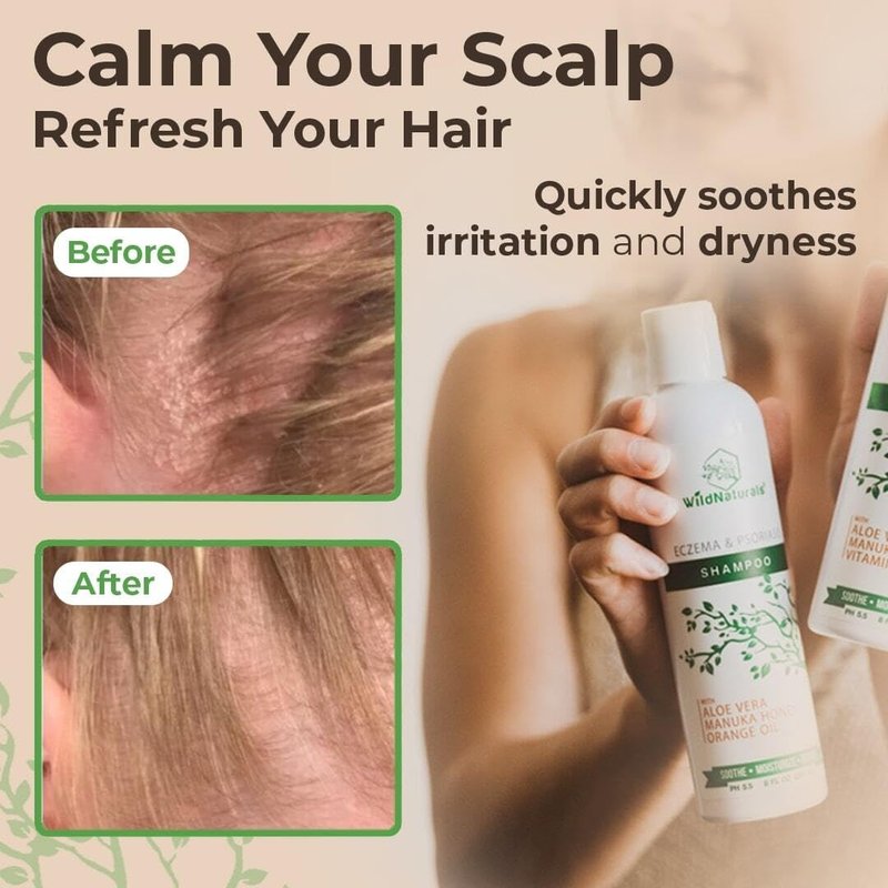 Wild Naturals Psoriasis Shampoo for Scalp Care & Relief – Hydrating Anti-Dandruff Shampoo for Itchy, Dry Scalp – Gentle Eczema Shampoo for Sensitive Skin