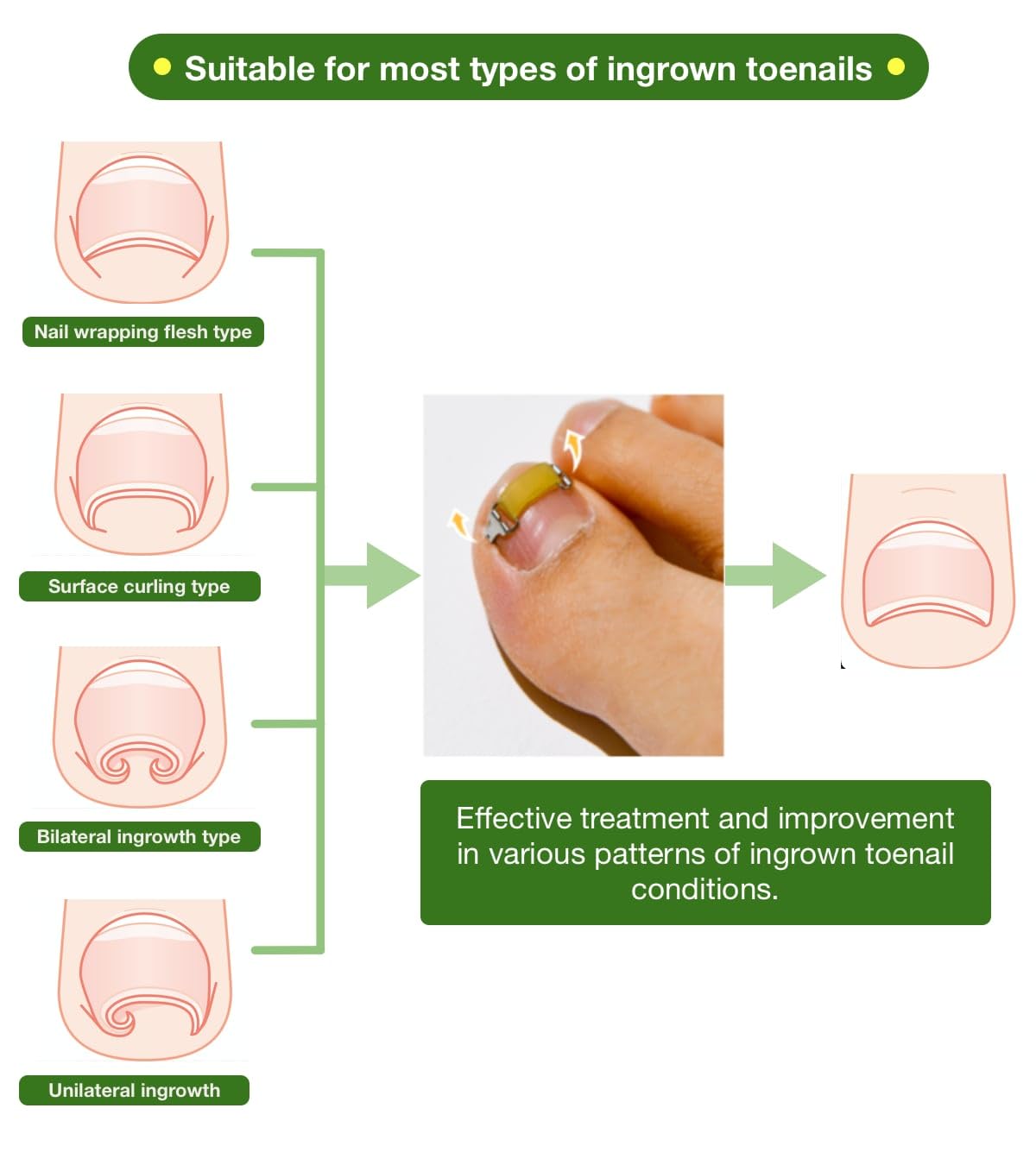 Ingrown Toenail Treatment & Corrector with Latex Elasticity - Curved Toenail Straightener | Effective Daily Solution for Ingrown Toenail Pain & Growth Correction [M/0.75inches/18-20mm]
