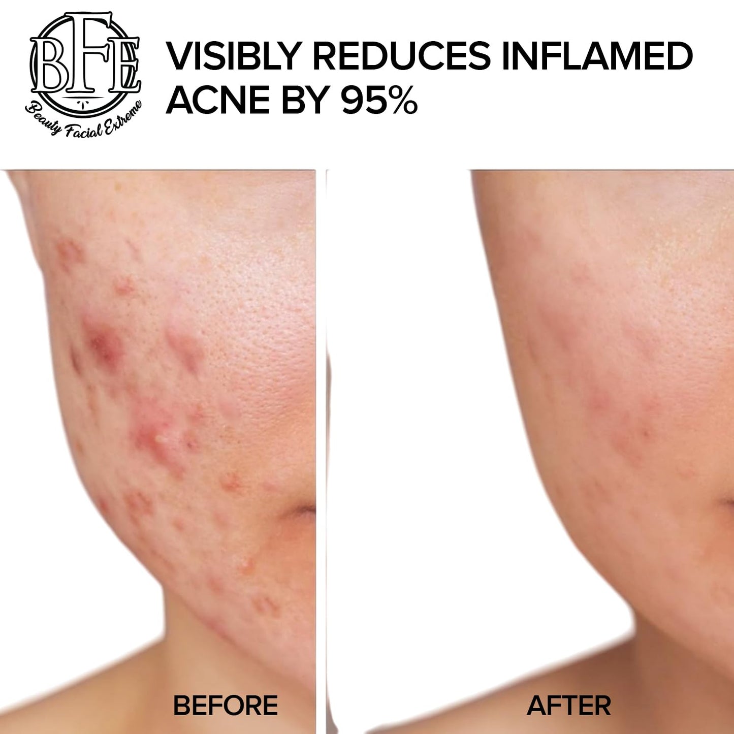 Acne Treatment Pads - Clear Cystic Breakouts & Clogged Pores | Improve Skin Texture & Reduce Dark Spots