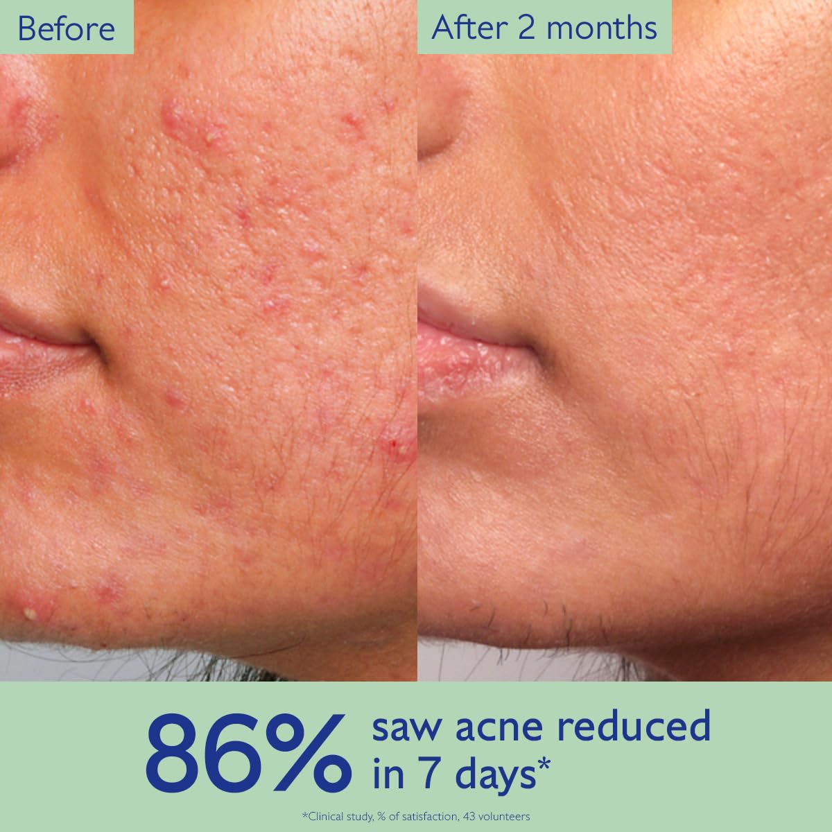 Caudalie Vinopure Acne Treatment, Salicylic Acid Serum to Treat and Prevent Blemishes - 30 mL
