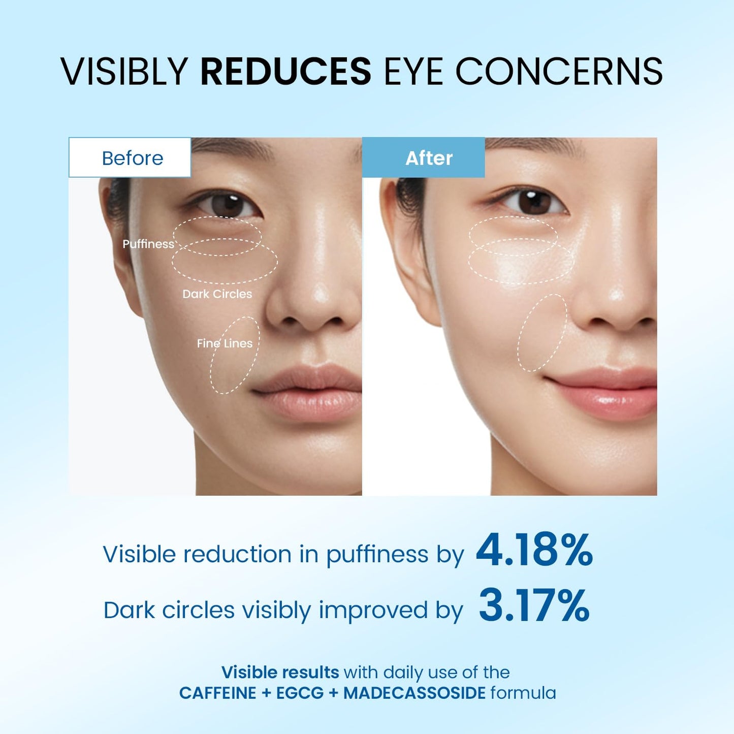 Dongyu Eye Cream for Dark Circles: Korean Caffeine Eye Cream Daily Morning Skincare - Puffy Eyes Treatment for Beauty Enthusiasts (Blue)