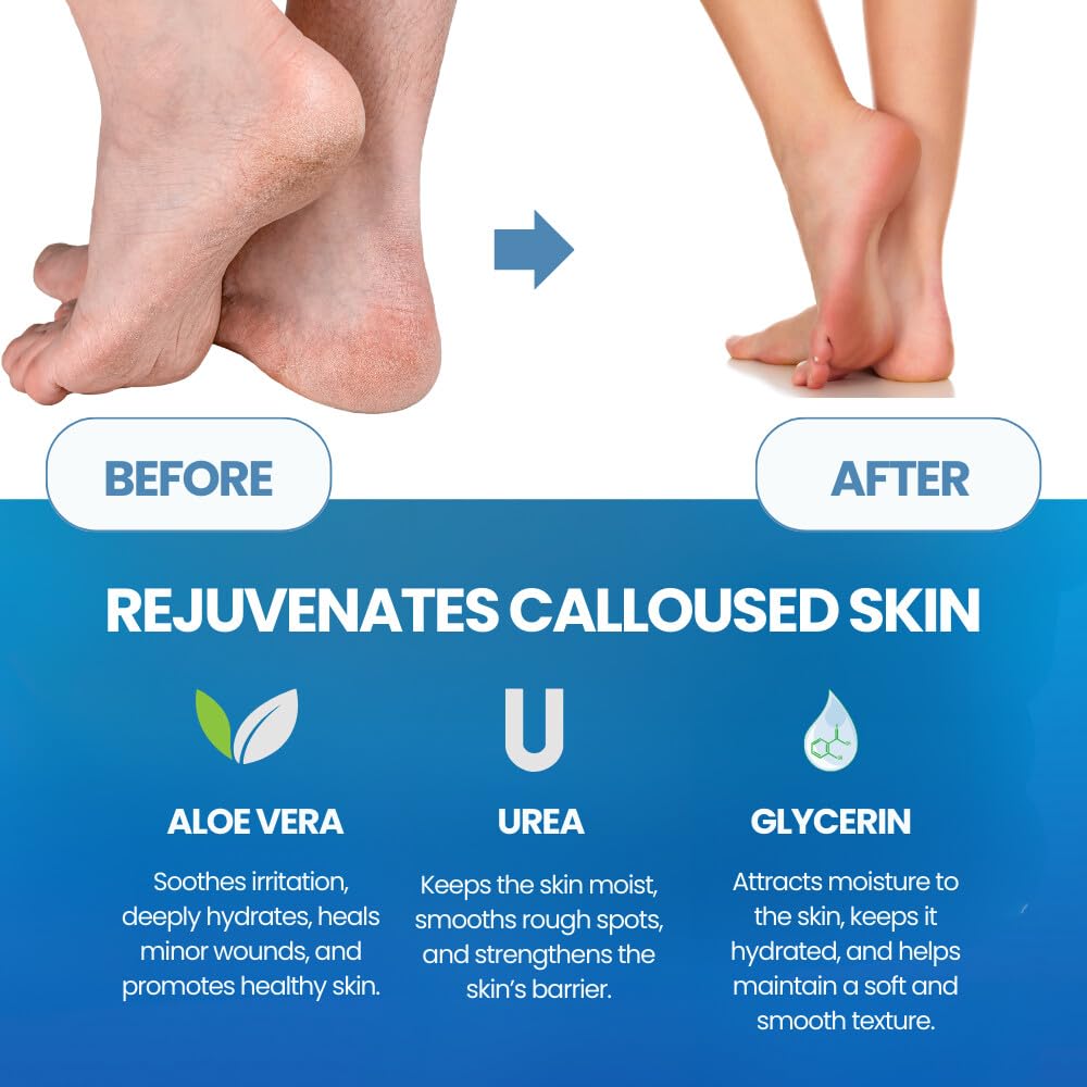 Imperial Feet Callus Remover for Feet Extra Strength Set – Callus Softener Spray + Stainless Steel Foot File, Hard Skin Remover for Dry Cracked Heels, Foot Dead Skin Remover for Pedicure
