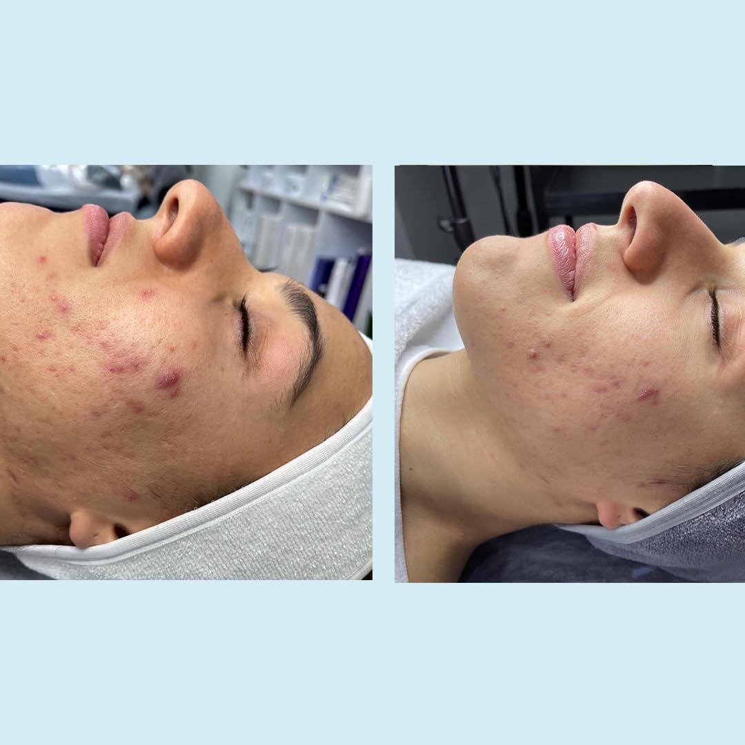 Salicylic Gel Chemical Peel - Enhanced with Green Tea Extract and Tea Tree Oil