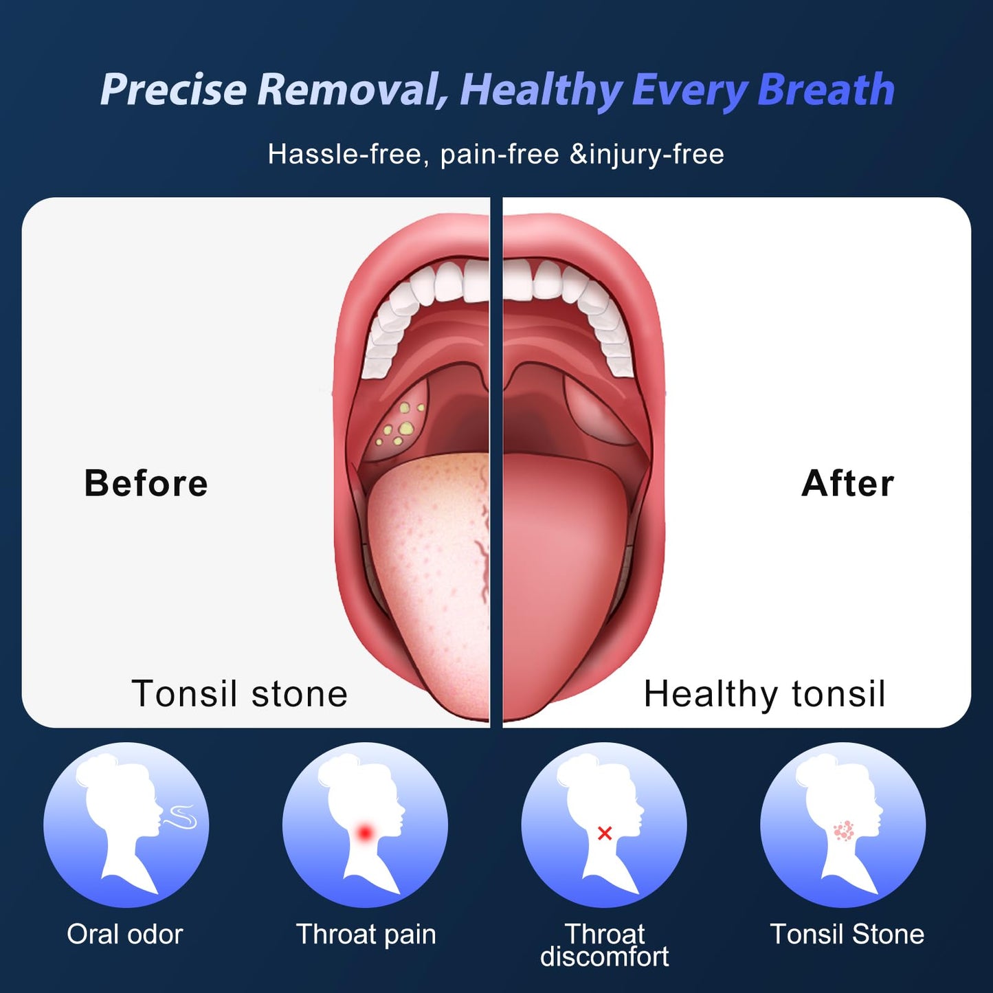 Upgraded Electric Tonsil Stone Remover – High-Precision & Painless Cleaning, Food-Grade Material, 6 Suction Levels | Tonsil Stone Removal Kit with LED Light, Oral Protection & 11 Attachments
